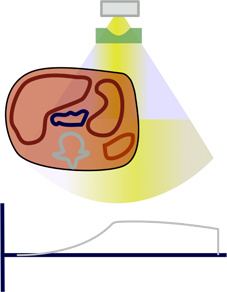 Patient mis-centering with bowtie filter